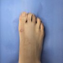 로에성형외과의원 | 대구 내성발톱 교정 후기｜수술 없이 통증 없이 해결 + 실비보험 적용까지