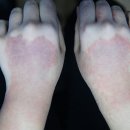 일로한의원 | 청주아토피치료 한의원 더 악화되기 전에