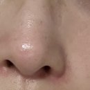 부천블라썸의원 | 토닝 , 잡티레이저 후기