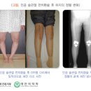 슬관절 전치환술[total knee arthroplasty] 이미지