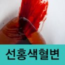 변색깔 선홍색 혈변 흑변현상 원인 이미지