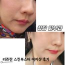NO.1 자동차피부과 | 리쥬란 스킨부스터 이지샷 솔직후기｜청담피부과 통증 효과 엠보싱 전후 총정리