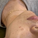 MS진단 | 대구 여드름관리후기/ 여드름자국 붉은흉터 진피콜라겐 재생관리MS에스테틱