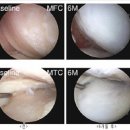 "줄기세포 주사로 무릎 연골 재생 치료 성공" 이미지