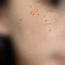 (주)엑셀온 | 전주 효자동 효천지구 피부과 , 엑셀브이 주근깨 레이저 내돈내산 (2) 일주일 후기