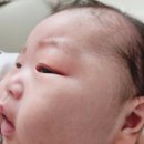 수원신경정신과의원 | 수원 설소대 소아과 신생아 시술 후기 (연세해맑은소아과)