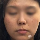 참을성 | 서울 리쥬란 후기 | 테토녀의 강남 피부과 리쥬란 (무통주사, 수면마취 없이 리쥬란 맞은 후기, 혐짤...
