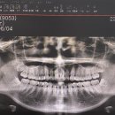 사랑니톡앤턱치과의원 | 수원 사랑니 발치 사랑니톡앤턱치과 겁쟁이의 인생 첫 사랑니 발치 후기