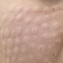 손의원 | 고덕동 비즈밸리 리쥬란 슬로아의원 손주사 후기