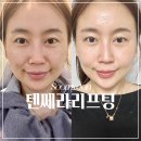 멍잎 | 서면피부과 텐쎄라리프팅 효과 및 통증 멍 붓기 솔직 후기