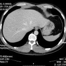 multiple hemangioma 이미지