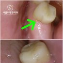 한스치과의원 | 치아 빠진 당뇨 환자, 다산동 치과 에서 안전하게 수면 임플란트 식립 후기