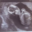 삼성의원 | 구파발 삼성레이디여성의원 임신초기 방문 후기