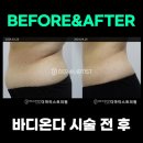 더마티스트의원 | 송도 온다리프팅 효과와 가격, 지방감소를 동시에