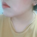 아이니크성형외과의원 | 압구정 "아이니크성형외과"에서 올뺌주사 1차 맞은 후기