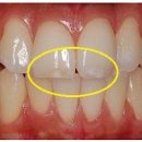 반상치 치아에 하얀 얼룩 화이트스팟 원인 치료 방법 이미지