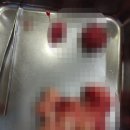 다빈치(주) | 자궁근종 8cm이상 다빈치 로봇수술 후기 3탄(최종)