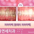[뉴욕연세치과] 원데이치아미백/자가미백2주 시술후기