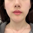 부천 옥길동 올타이트리프팅 400샷 효과 후기