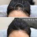 마음에점을찍다두피SMP 이미지