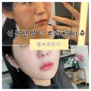 멍쥬 | 신논현역피부과 릴리쥬 리쥬란힐러와 릴리이드를 한번에! 릴리쥬 내돈내산 솔직후기