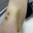 제일금속 | 경비골 골절 수술 4주차/금속정 수술 후기