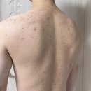 정수한의원 | 노원에 있는 해율한의원에서 등 여드름 치료 끝장낸 후기
