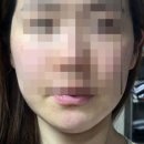 스마일뷰티시스템즈(주) | 뷰앤디 앤모드프로, 아이리쥬브 두 달 솔직후기 - 땅콩형 얼굴·심부볼 처짐 진짜 개선될까?