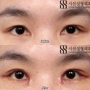 시선성형외과의원 네이버블로그