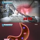 양배추보다 좋다! '급성 위염' 극복에 최고인 식재료는? 이미지