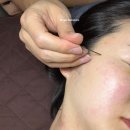 화랑대역 2번출구 버스정류장 | 내돈내산 대전 편평사마귀 제거 후기, 거우침 으로 통증없이 제거한 둔산동 한의원