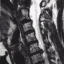 목 디스크 (경추 추간판 탈출증, Cervical HIVD) 이미지