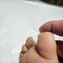 비전태권도 | 수영장, 태권도 다니는 초1, 바이러스성 사마귀 치료후기