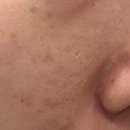 바름한의원 | 수원여드름한의원 트랜스테라피 새살침 1회차 솔직후기