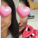 이쁜얼굴 | 실리프팅 얼굴지방흡입 후기 (안면윤곽후 관리)
