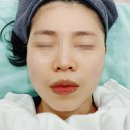 쿨 | 통증없는 리프팅 쿨페이즈 후기 수원피부과 다녀옴