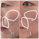 미스토리 | [공지] [내돈내산]세종 피부관리 찐단골샵 소개! 미스토리세종점 -중요한 행사전날 소프트플라즈마 적극...