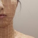 연세수가정의학과의원 | 연세 보드미의원 편평사마귀 제거 후기 (얼굴, 목, 상반신 앞/뒤)