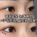JT빌딩 | 날카로워 보이는 눈매 : 순한 이미지_뒤트임, 밑트임 성형 후기