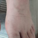 한양류마플러스내과의원 | 엄지발가락 붓기와 통증, 통풍 검사 후기｜세종류마플러스병원 진료 경험