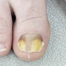 화성디에스병원 | 화성 내성발톱 무좀 병원에서 통증 없이 스케일링부터 오니코 레이저까지