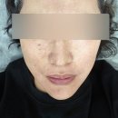 코스모의원 | [마포 이멀스의원]오래된 편평사마귀 제거 282개