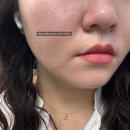 예스케어 - 유성구 | 선릉 피부과 예스필 6세대 필링 저자극 각질 케어 후기