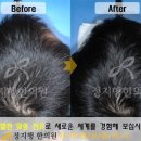 정지행한의원 | 정지행한의원 후기 !! 한방탈모치료가 좋아요 ~ 원형탈모로 고생했네요