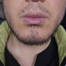 루미의원 | 입술 포다이스반, 1년 반 만에 후기(feat. 루미의원)