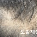 더블라인스칼프 네이버블로그