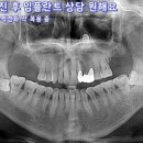 서울바른플란트 네이버블로그