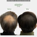 전주바로병원 | 전주 익산 군산 smp 탈모병원 가격 비용 효과 후기 진짜 후회합니다