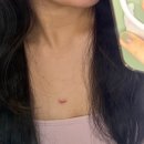 연세스타병원 | 가슴켈로이드 흉터치료 후기 1편(연세스타강남 레이저+주사 병행)