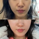 여의도피부과 쥬베룩 볼륨 한병 후기